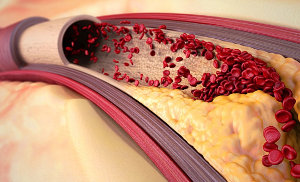 Настои, которые легко очистят вены и артерии